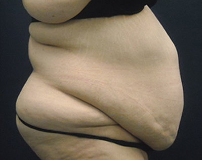 Chicago tummy tuck, Chicago panniculectomy, tummy tuck photo, tummy tuck picture, tummy tuck photograph, abdominoplasty photo, abdominoplasty picture